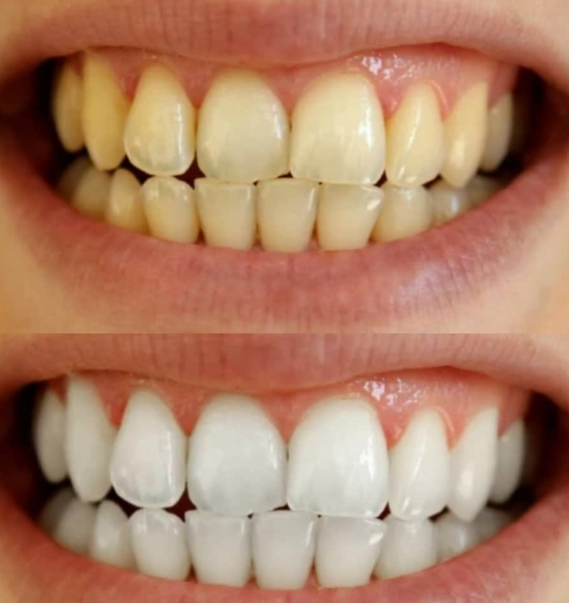 Tooth Whitening